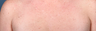 Fraxel Laser on Chest
