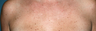 Fraxel Laser on Chest