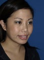 Revision Rhinoplasty with Chin Implant