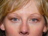 Upper Eyelid Surgery