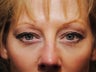 Upper Eyelid Surgery