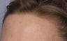 Limelight IPL to Forehead