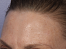 Limelight IPL to Forehead