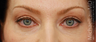 Eye Bag Surgery