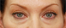 Eye Bag Surgery