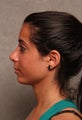 Chin Implant