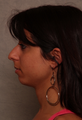 Chin Implant