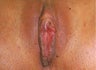 Labiaplasty