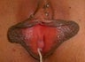Labiaplasty