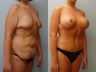Massive Weight Loss 1