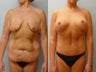 Massive Weight Loss 1