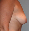 Breast Lift