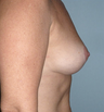 Breast Lift