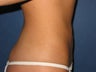 26 Year Old Liposuction