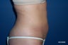 26 Year Old Liposuction