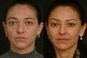 Midface Fat Trasfer
