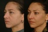 Midface Fat Trasfer