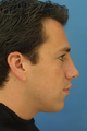 Nasal Fracture Repair