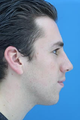 Nasal Fracture Repair