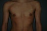 FTM top surgery. Keyhole approach and periarolar mastopexies, (incisions around nipple to decrease size).