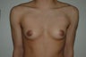 FTM top surgery. Keyhole approach and periarolar mastopexies, (incisions around nipple to decrease size).