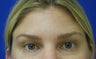 Forehead Lines