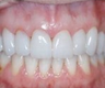 Veneers