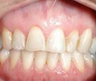 Veneers