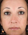 Female Patient Treated with Restylane® & Perlane®