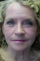 CO2 Laser Resurfacing