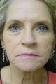 CO2 Laser Resurfacing
