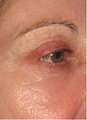63 Year Old Female Treated for Wrinkles Around the Eye with Total Fx