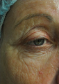 63 Year Old Female Treated for Wrinkles Around the Eye with Total Fx