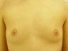 Female Patient Before and After Breast Lift