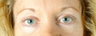 Eyelid Lift