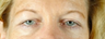 Eyelid Lift