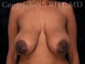 Breast Lift (mastopexy)