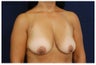 Breast Lift