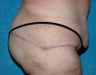 Buttock Augmentation with Circumferential Body Lift