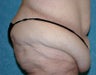 Buttock Augmentation with Circumferential Body Lift