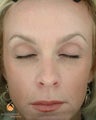 Female Patient Treated with BOTOX® Cosmetic