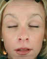 Female Patient Treated with BOTOX® Cosmetic