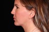 40 Year Old Female Cheek and Neck Lift and Chin Implant