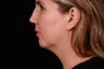 40 Year Old Female Cheek and Neck Lift and Chin Implant