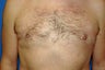 Gynecomastia procedure