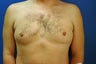 Gynecomastia procedure