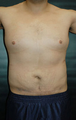 Male Tummy Tuck