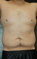 Male Tummy Tuck
