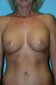 Breast Lift