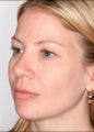 Rhinoplasty